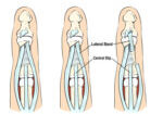 Cirugía de injerto de banda lateral del dedo para el tratamiento del tendón extensor