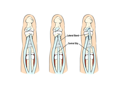 Cirugía de injerto de banda lateral del dedo para el tratamiento del tendón extensor