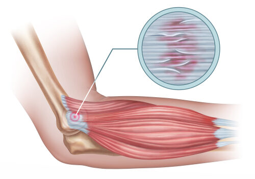 Diagramme,du,tennis,elbow,montrant,un,détail,du,tendon,endommagé