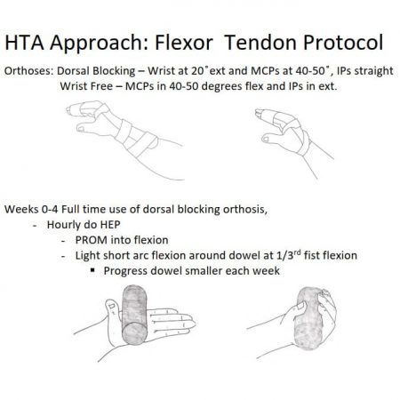 Flexor Tendon Treatment