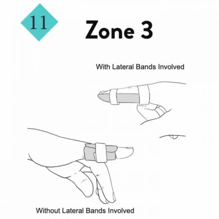 Extensor Tendon Zones