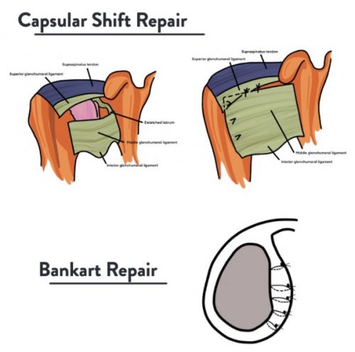 Shoulder Pain Rehab