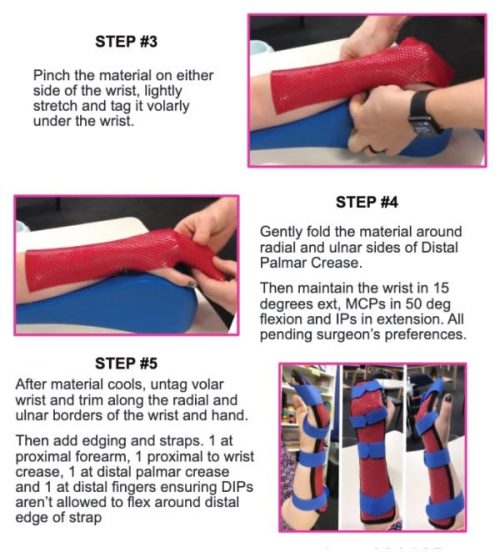 Hand Therapy Splinting